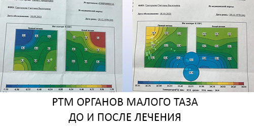 РТМ до и после лечения